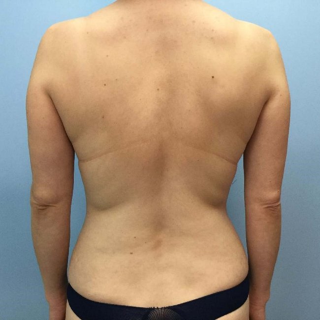 Before Image of Mommy Makeover Back Side View p-6382