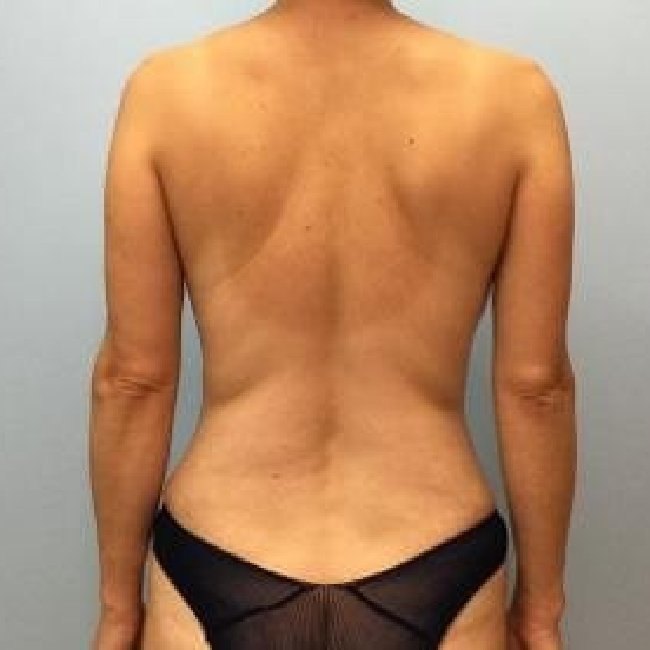 After Image of Mommy Makeover Back Side View p-6382