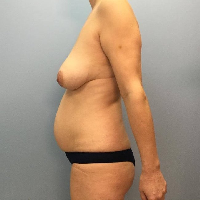 Before Image of Mommy Makeover Left Side View p-6382
