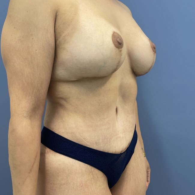 After Image Mommy Makeover Post Gastric Sleeve Right Side 45 degree View P-6393