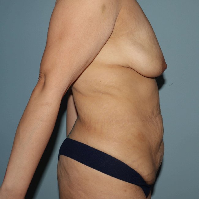 Before Image Mommy Makeover Post Gastric Sleeve Right Side View P-6393