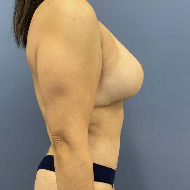 After Image Mommy Makeover Post Gastric Sleeve Right Side View P-6393