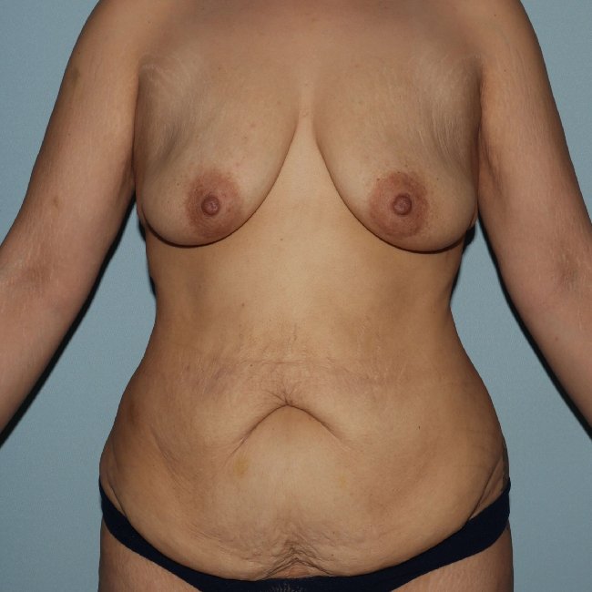 Before Image Mommy Makeover Post Gastric Sleeve Front Side View P-6393