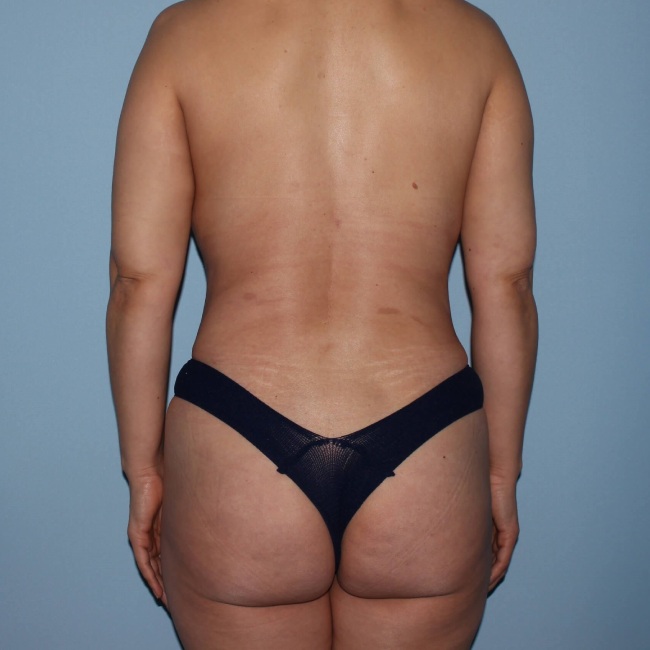 After Image Mommy Makeover with Fat grafting to Buttock Back View Patient 7645