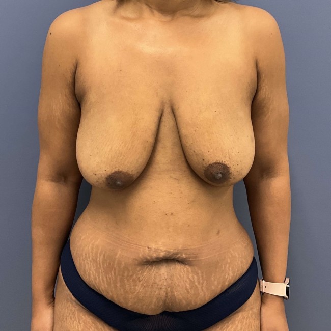 Before Image Mommy Makeover after Bariatric Weight Loss Front View Patient 7666