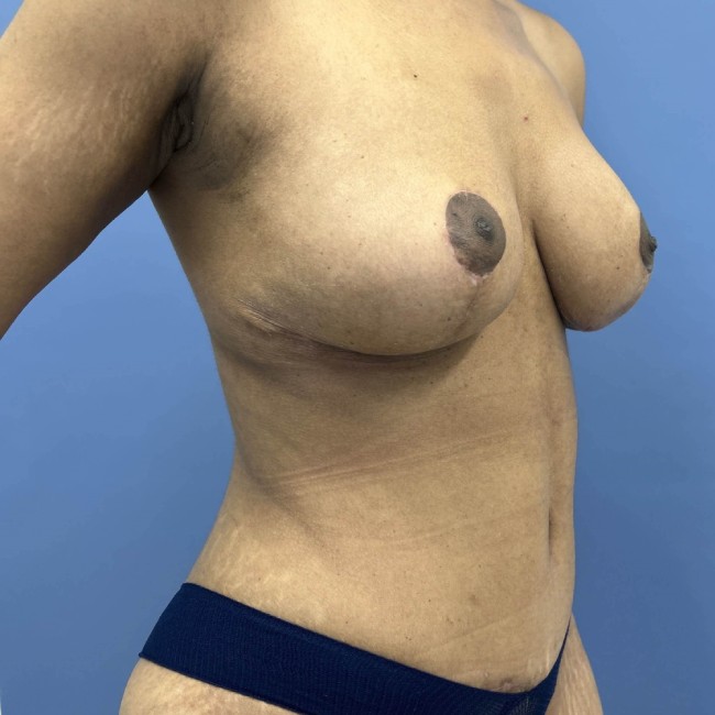 After Image of Mommy Makeover after Bariatric Weight Loss Right Side 45 degree View Patient 7666