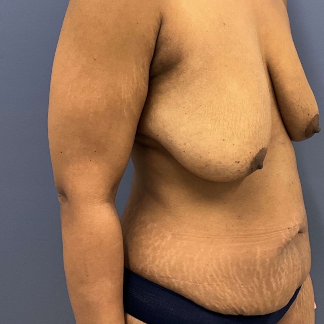 Before Image Mommy Makeover after Bariatric Weight Loss Right Side 45 degree View Patient 7666
