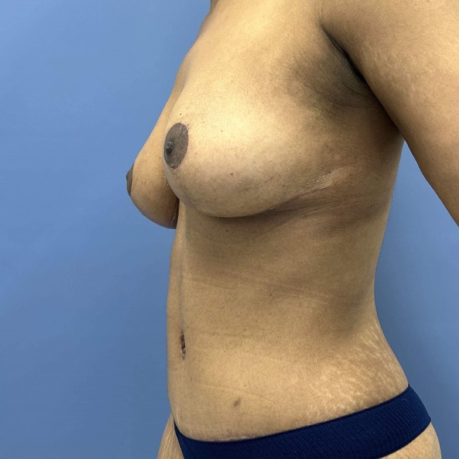 After Image of Mommy Makeover after Bariatric Weight Loss Left Side View Patient 7666