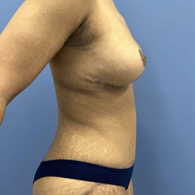After Image of Mommy Makeover after Bariatric Weight Loss Right View Patient 7666