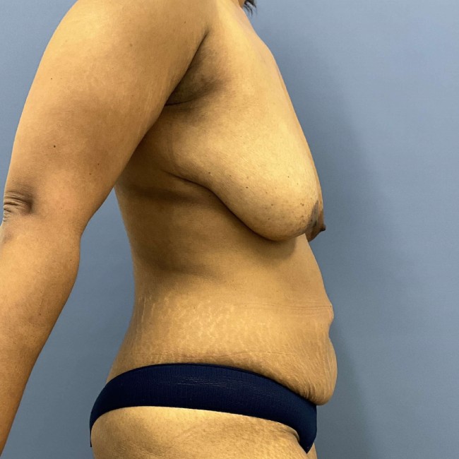 Before Image Mommy Makeover after Bariatric Weight Loss Right Side View Patient 7666