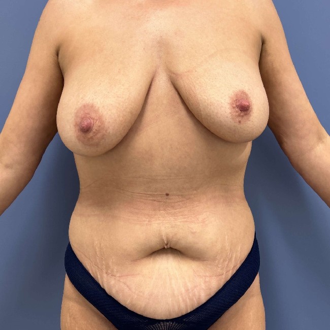 Before Image of Mommy Makeover After Ozempic Front Side View P-7682