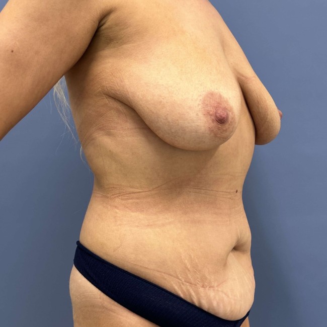 Before Image of Mommy Makeover After Ozempic Right Side 45 degree View P-7682