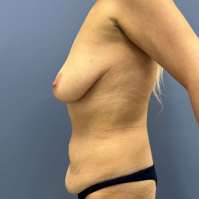 Before Image of Mommy Makeover After Ozempic Left Side View P-7682