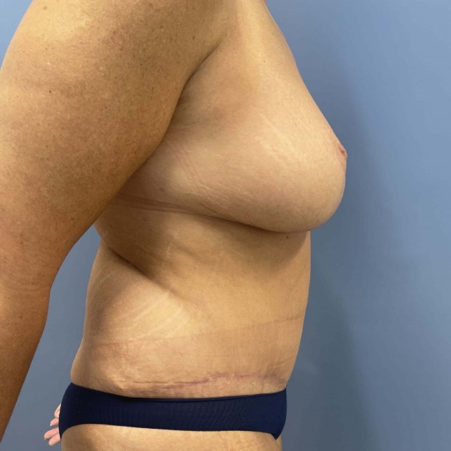 image after mommy makeover after weight loss - right angle case 7691