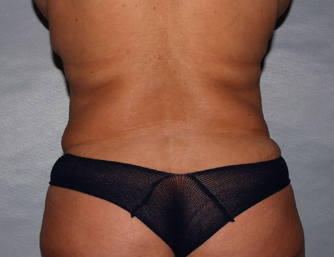 image after mommy makeover - 47yr old patient back view case 6334