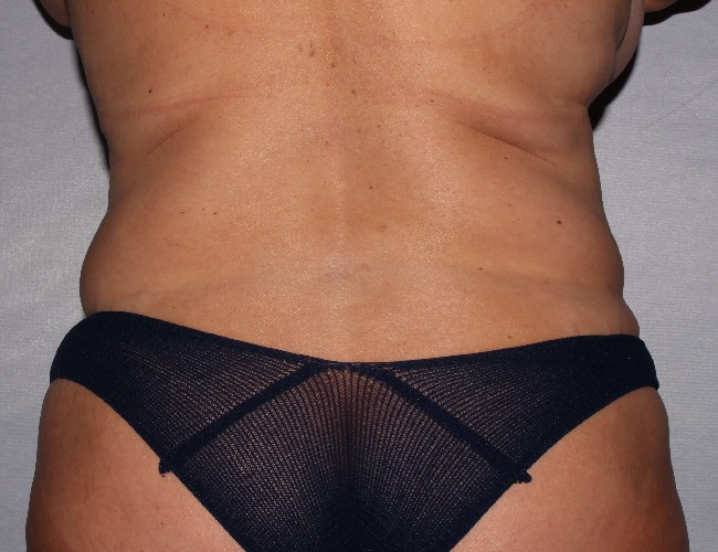 image before mommy makeover - 47yr old patient back view case 6334
