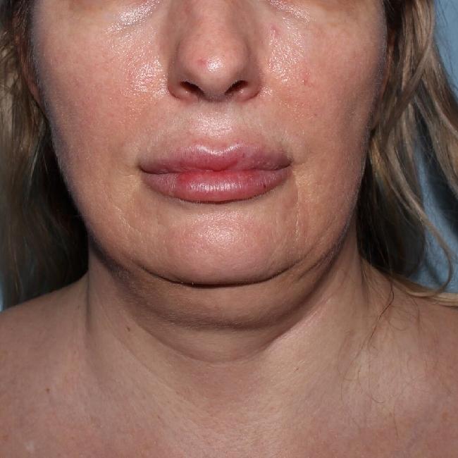 image before myellevate - sagging neck front view case 6635