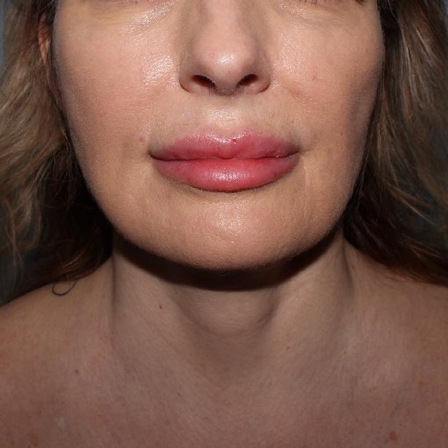 image after myellevate - sagging neck front case 6635