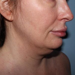 image before myellevate - sagging neck 45 degrees right angle case 6635