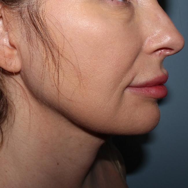 image after myellevate - sagging neck 45 degrees right angle case 6635