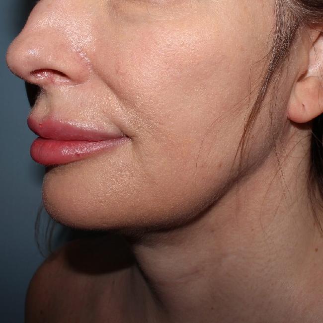 image after myellevate - sagging neck 45 degrees left angle case 6635