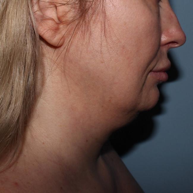 image before myellevate - sagging neck right angle case 6635