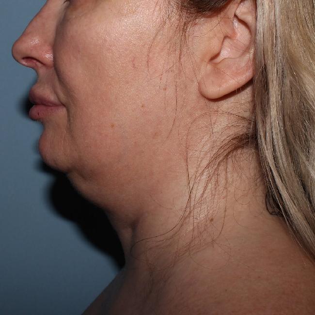 image before myellevate - sagging neck left angle case 6635
