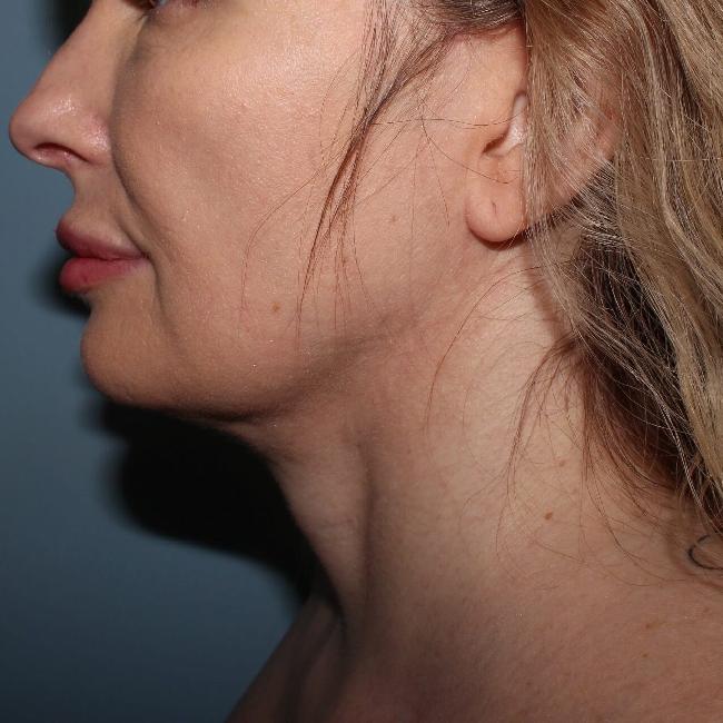 image after myellevate - sagging neck left angle case 6635