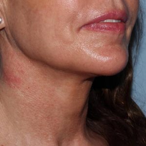 image after myellevate - minimally invasive neck lift 45 degrees right angle case 6650