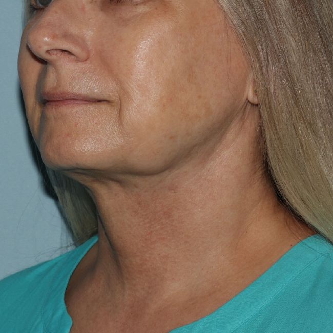 image after myellevate - zoom lift 45 degrees left angle case 6443