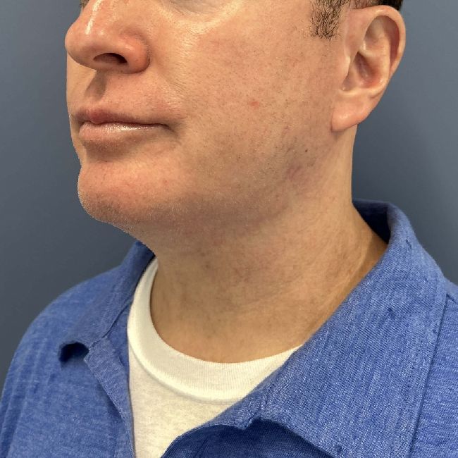 image after myellevate jawline contour - male patient 45 degrees left angle case 6464