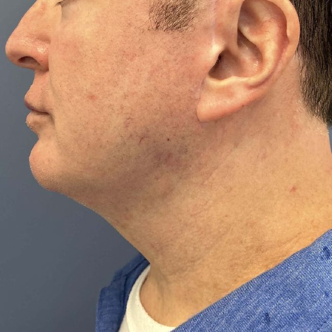 image after myellevate jawline contour - male patient left angle case 6464