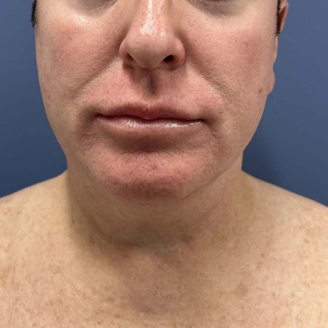image before myellevate jawline contour - male patient front view case 6464