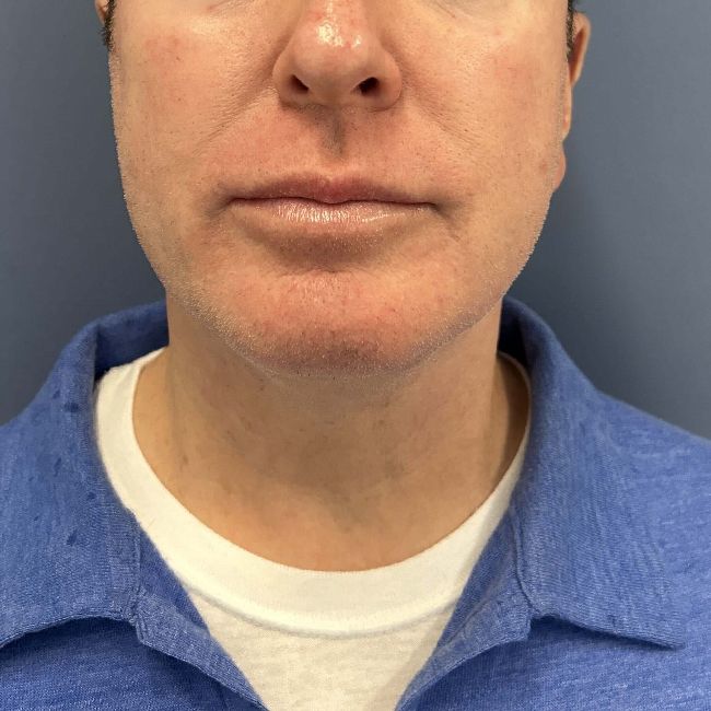 image after myellevate jawline contour - male patient front view case 6464