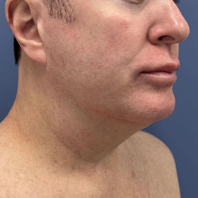 image before myellevate jawline contour - male patient 45 degrees right angle case 6464