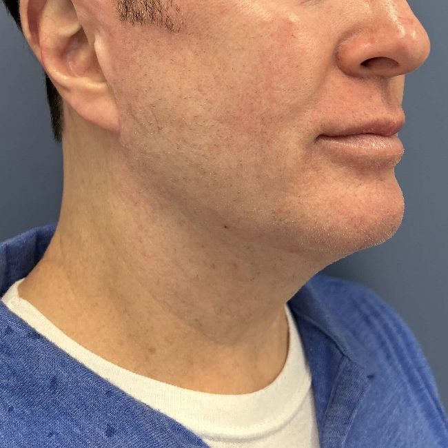 image after myellevate jawline contour - male patient 45 degrees right angle case 6464