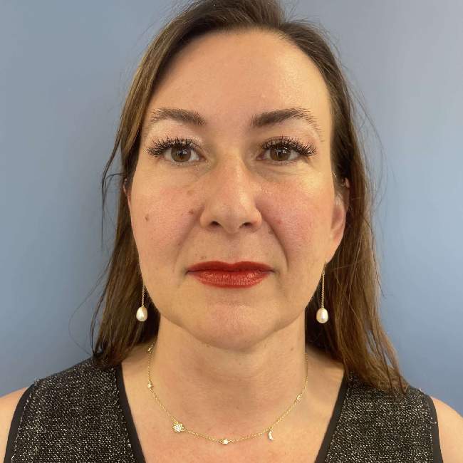 after myellevate front view case 6621