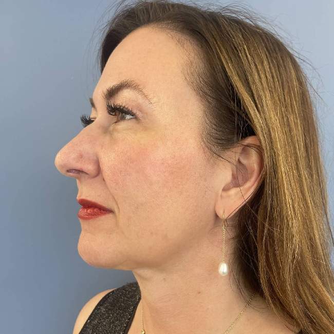 after myellevate 45 degrees left angle case 6621