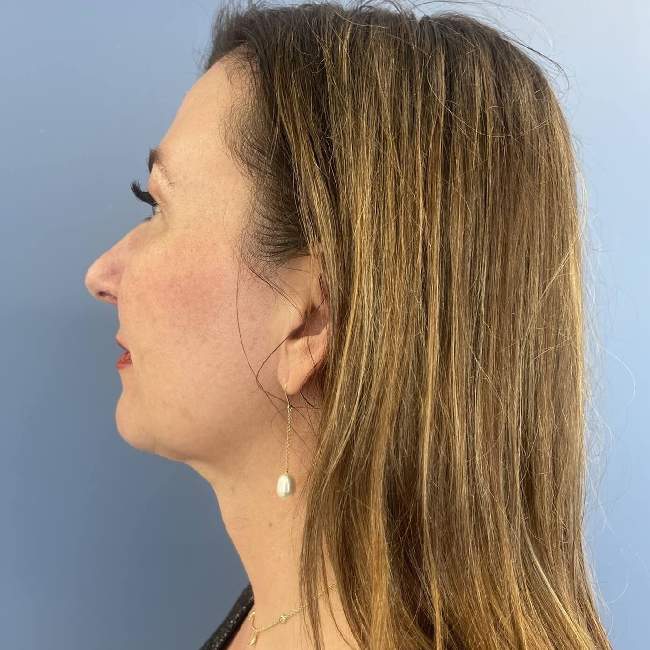 after myellevate left angle case 6621