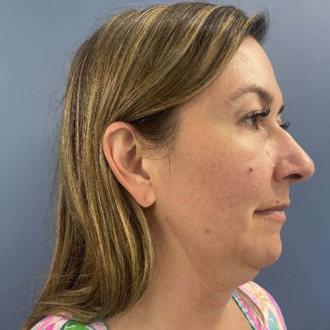 before myellevate 45 degrees right angle case 6621