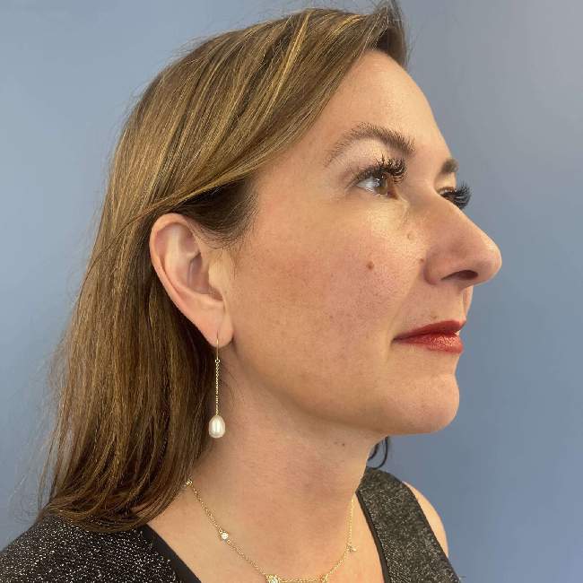 after myellevate 45 degrees right angle case 6621