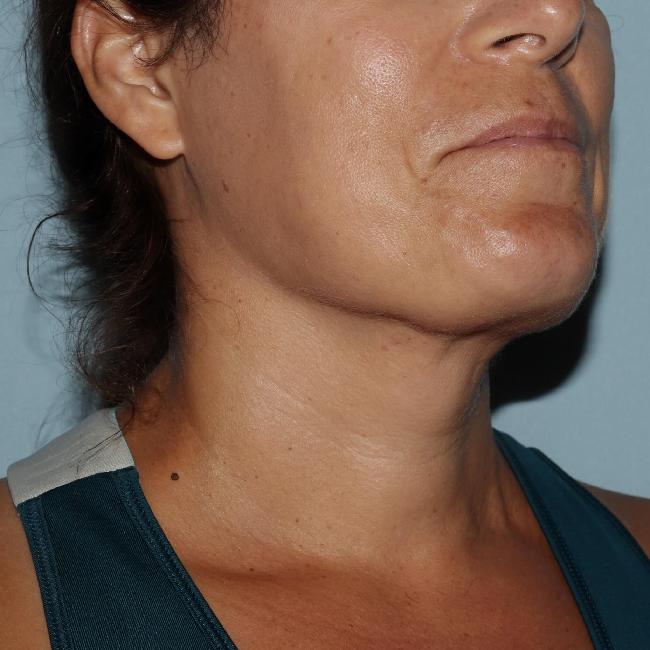 image after myellevate - zoom lift right angle case 6680