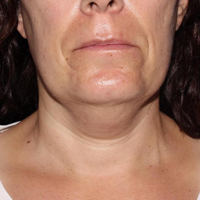 image before myellevate - zoom lift front view case 6680