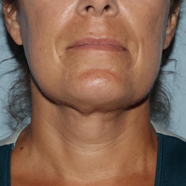 image after myellevate - zoom lift front view case 6680