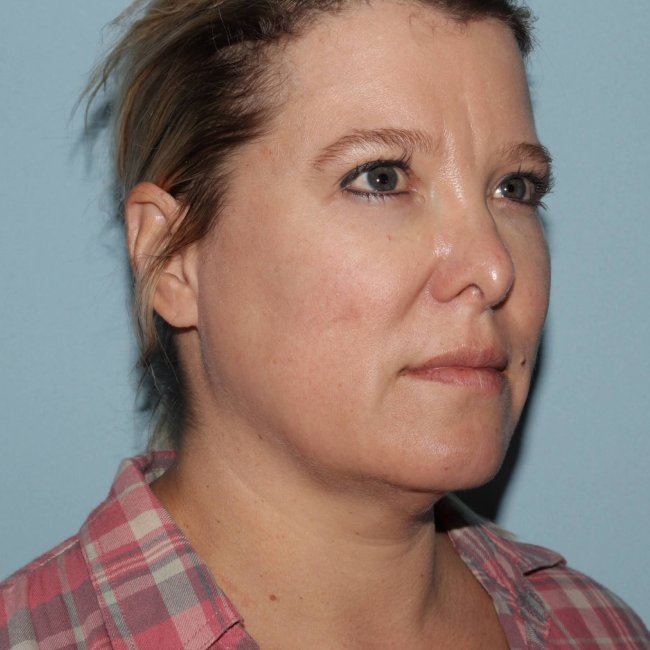 image before myellevate - zoom lift minimally invasive neck lift 45 degrees right angle case 7202