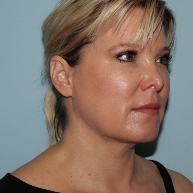 image after myellevate - zoom lift minimally invasive neck lift 45 degrees right angle case 7202