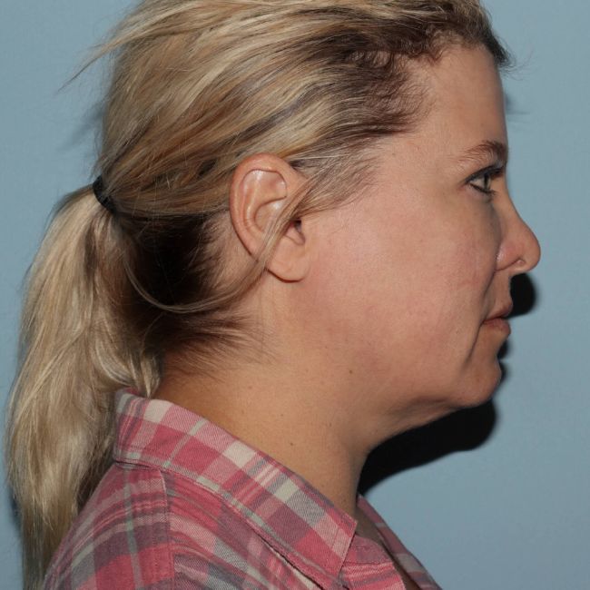 image before myellevate - zoom lift minimally invasive neck lift right angle case 7202