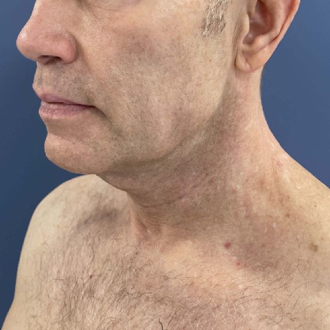 image before myellevate - male adult patient 45 degrees left angle case 6455