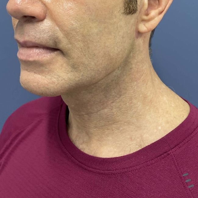 image after myellevate - male adult patient 45 degrees left angle case 6455