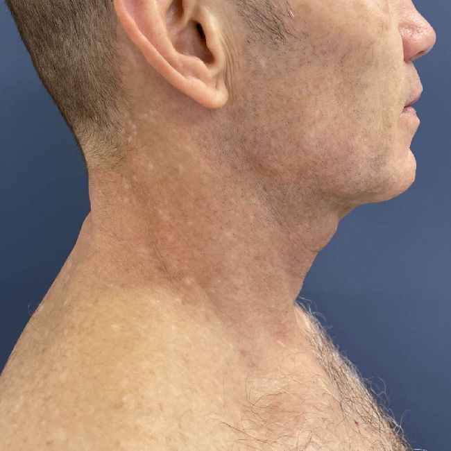 image before myellevate - male adult patient right angle case 6455